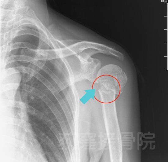 肋骨 打撲 と 骨折 の 違い